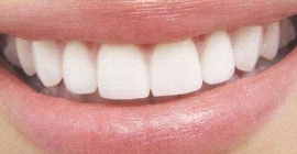 Estetik Diş Tedavileri