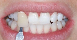 Tooth Whitening (Bleaching)