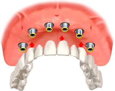 sabit diş implant